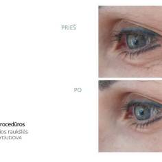silk pries ir po 1